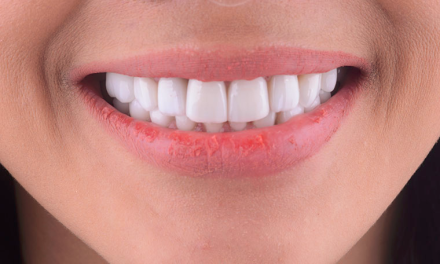 Mempercantik Gigi Dengan Tindakan Veneer Yang Benar