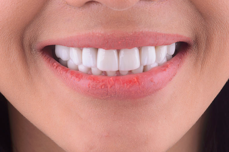 Mempercantik Gigi Dengan Tindakan Veneer Yang Benar
