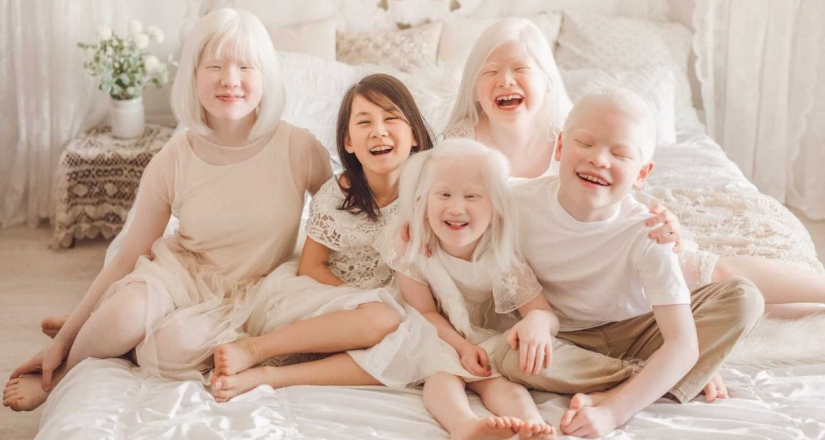 Kelainan Jenis Genetika Kulit Pada Manusia Albino