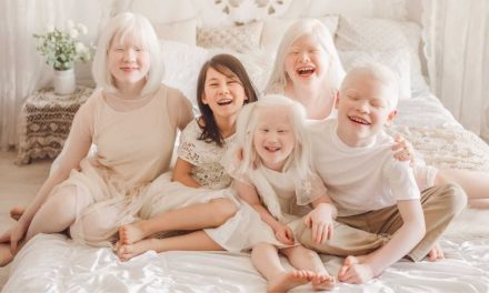 Kelainan Jenis Genetika Kulit Pada Manusia Albino