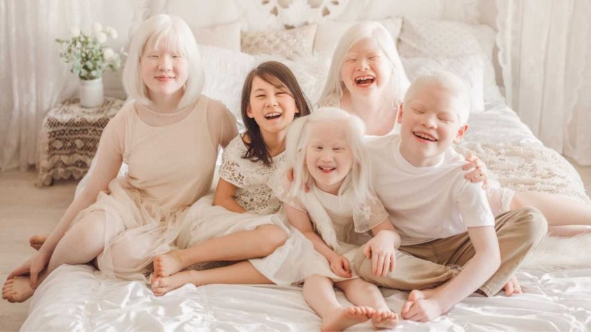 Kelainan Jenis Genetika Kulit Pada Manusia Albino